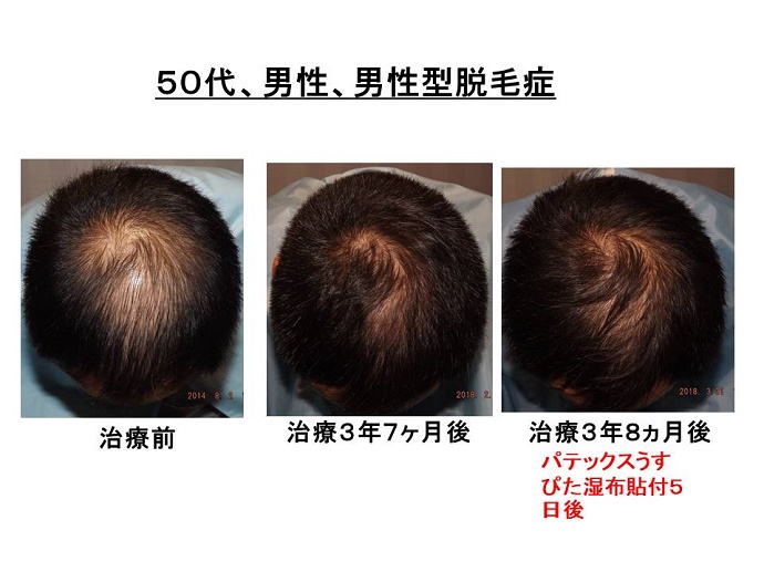 円形脱毛症　病院